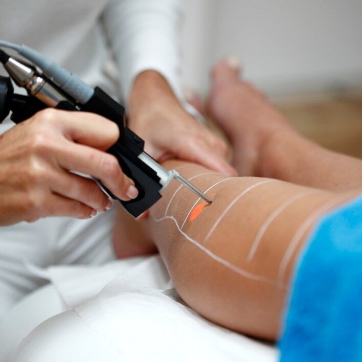 épilation au laser